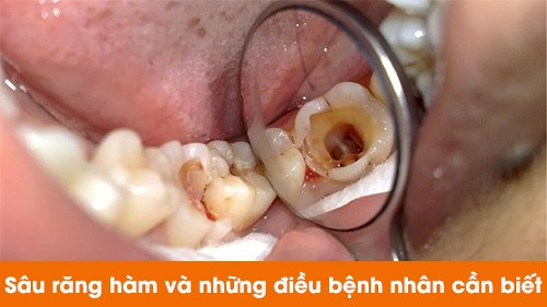 Sâu răng hàm và những điều bệnh nhân cần biết